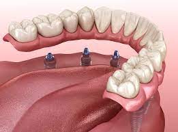 Docprime is an online platform that enables the users in connecting with some of the experienced nearby dentists. Denture Care Center Professional Dental Lab Services Smile Bright Dentures