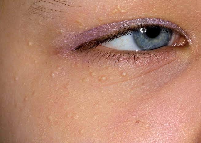 Milia (Milk Spots): Why They Appear and How to Remove Them