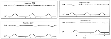 Image result for Contraction Stress Test