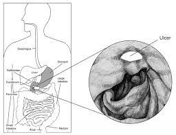 Helicobacter Pylori H Pylori Testing Lab Tests Online