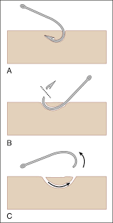 Image result for Fishhook Removal