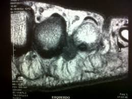 neuroma de morton