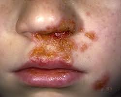Image result for yellow scabs on the face in children