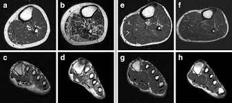 It arises from the base of the fifth metatarsal bone, and from the sheath of the fibularis longus. Accelerated Atrophy Of Lower Leg And Foot Muscles A Follow Up Study Of Long Term Diabetic Polyneuropathy Using Magnetic Resonance Imaging Mri Springerlink