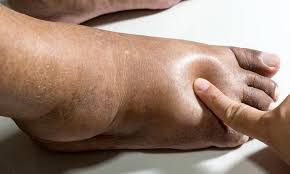 Image result for black toe diabetes