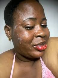 WHAT WILL I DO TO STOP SIEVIER PAIN IN MY BODY