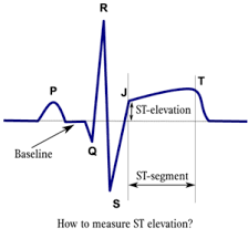 Image result for ST Elevation