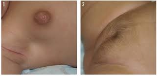 Image result for Precocious Puberty