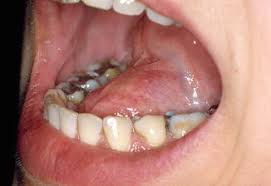 Introduction fibroma is a benign neoplasm of fibroblastic origin and it is rare in the oral cavity (scully, 2010). Diseases Of The Oral Mucosa And Soft Tissues General Aspects Pocket Dentistry