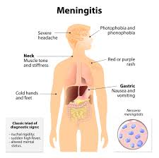 Developing a headache and rash, or any symptoms that could indicate meningococcal meningitis can be frightening. Meningitis Symptoms Slideshow Causes Treatment In London