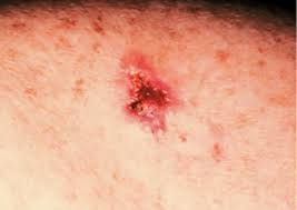 Skin cancer is one of the most common types of cancer. Basal Cell Carcinoma Warning Signs And Images The Skin Cancer Foundation