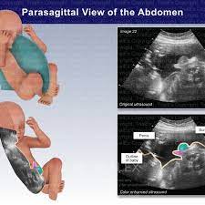 Parasagittal View of the Abdomen: Ultrasound
