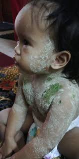 ^ chicken pox parties do more harm than good, says doctor. Chickenpox Selain Guna Losyen Dari Klinik Ibu Ni Kongsi Petua Lain Untuk Cepat Sembuh Keluarga