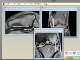 The mri results are actually back within an hour or two, if it is an emergency. How To Read An Mri 15 Steps With Pictures Wikihow