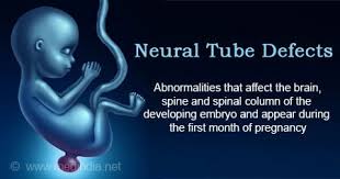 Neural Tube Defects - Types, Causes ...