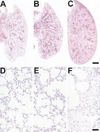 Bronchiole | alveolar duct | alveoli | em alveoli septum | alveoli elastin | trachea 1 | trachea 2 | labeled lung | unlabeled lung | respiratory bronchiole | lung reticular fibres | nasal inferior concha | nasal respiratory epithelium | olfactory region overview | olfactory region epithelium | histology stains. Lung Histology H E Stain Demonstrating Pulmonary Edema At Day 5 After Download Scientific Diagram