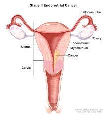 Uterine cancer occurs when cancer cells form in the muscles of the uterus or tissues that support the uterus. Endometrial Cancer Hematology Oncology Associates Of Cny