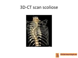 Ct Scan Rug Hernia Ct Scan Machine