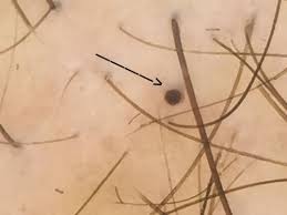 An ovarian follicle contains a hollow ball of cells with an immature egg in the center. Black Dots Hair Dye As An Example Donovan Hair Clinic