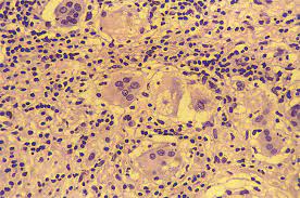 La miocarditis es la inflamación del músculo cardiaco. Miocarditis De Celulas Gigantes Presentacion De Un Caso Revista Espanola De Cardiologia