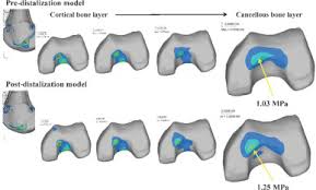 Your knee mri will often show a: Finite Element Analysis For Investigation Of The Etiology Of Osteochondritis Dissecans In Medial Femoral Condyle Osteoarthritis And Cartilage