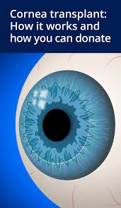 When Do You Need A Cornea Transplant Corneal Transplant Transplant Eyes Problems