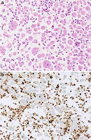 We did not find results for: Malignant Mesothelioma In Pleural Effusion Sample A Hypercellular Download Scientific Diagram