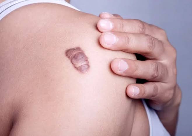 Keloid Removal In Tampa, FL | Over 100 5-Star Reviews