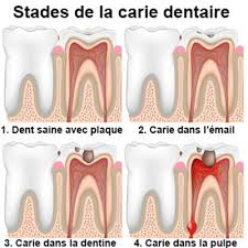 Evolution d'une carie dentaire : Que Faire En Cas De Carie Dentaire Docteurclic Com