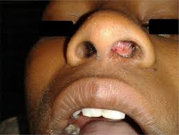 There are different types of tumors, some of which are benign and some of which are cancerous. Frontal Recess Polyp In A 14 Year Old Child Resembling An Antro Choanal Polyp Sciencedirect