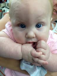 Renae's journey with Trigonocephaly Metopic Craniosynostosis.