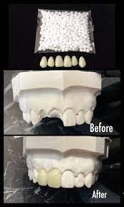Missing Tooth Kit Select Your Teeth Front Flipper Denture Etsy Dental Veneers Denture Dental Adhesive