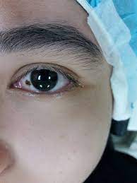 🐱 muka penuh taik mata 🐱 telinga berkerapu/kurap 🐱 bulu banyak gugur 🐱 ada kutu ewww 🐱 selsema memanjang. Risau Tahi Lalat Klinik Pakar Mata Surgeri Faiezah Facebook