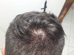 Un grand nombre de gènes identifiés dans ces travaux jouent un rôle dans la structure. Photos Debut De Calvitie International Hair Loss Forum