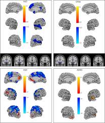 Check spelling or type a new query. Structural Neuroimaging Correlates Of Social Deficits Are Similar In Autism Spectrum Disorder And Attention Deficit Hyperactivity Disorder Analysis From The Pond Network Translational Psychiatry