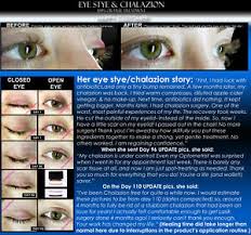 We did not find results for: 4 Before And After Eye Stye And Chalazion Removal Remover Relief Eyelid Bump Ebay