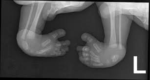 Most of the time, it is not associated with other problems. Talipes Equinovarus Clubfoot Radiology Case Radiopaedia Org