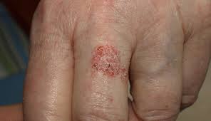 1,5 melanoma is the third most common type of skin cancer and is much more deadly. 10 Signs And Symptoms Of Skin Cancer Lifeberrys Com