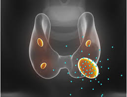 Image result for Hyperparathyroidism