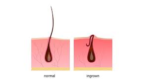 The ingrown concentrate, including tea tree oil and coconut oil, is then meant to be used on ingrown hairs that have already sprouted or on sensitive skin daily to prevent bumps. Using Laser Hair Removal To Eliminate Ingrown Hair Vibrance Medspa