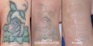 Talk to bandak plastic surgery in charleston, wv do you have a tattoo that you regret and no longer like? Laser Tattoo Removal Charleston Sc O Neill Plastic Surgery