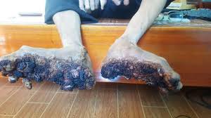 Epidermodysplasia verruciformis (ev) er en ekstremt sjelden hudtilstand som kan forårsake barklignende vekst. Two Treeman Syndrome Cases Reported In Vietnam Vietnamnet