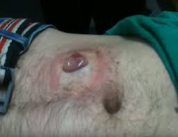 Having an infected ingrown hair is most commonly caused by shaving or waxing your arms, chest, back, pubic area, legs, face, and underarms. Infected Ingrown Hair Cyst Archives New Pimple Popping Videos