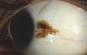 Image result for melanosis sclera