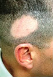 Progesterone deficiency hair loss himalaya hair loss cream review himalaya anti hair loss cream side effects. Is Man Balding Just Like Dad Clinician Reviews