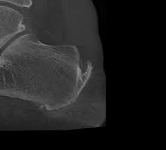 Haglund exostosis is a rare bony prominence on the heel bone near the achilles tendon insertion. Haglund Syndrom Ortho Pede Zentrum Fur Fuss Und Sprunggelenk