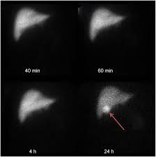 Image result for HIDA Scan