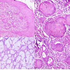 We did not find results for: Pdf Histopathology And Its Role In Diagnosing Necrotizing Sialometaplasia A Report Of Three Cases Indirani Vl Gayathri Ramesh Gauri Mishra Amrita Raj