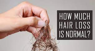 Hair loss (alopecia) can affect just your scalp or your entire body, and it can be temporary or permanent. How Much Hair Loss Is Normal These Statistics Are Real