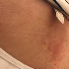 Hautausschlag Am Rucken Juckt Gesundheit Und Medizin Pilze Juckreiz